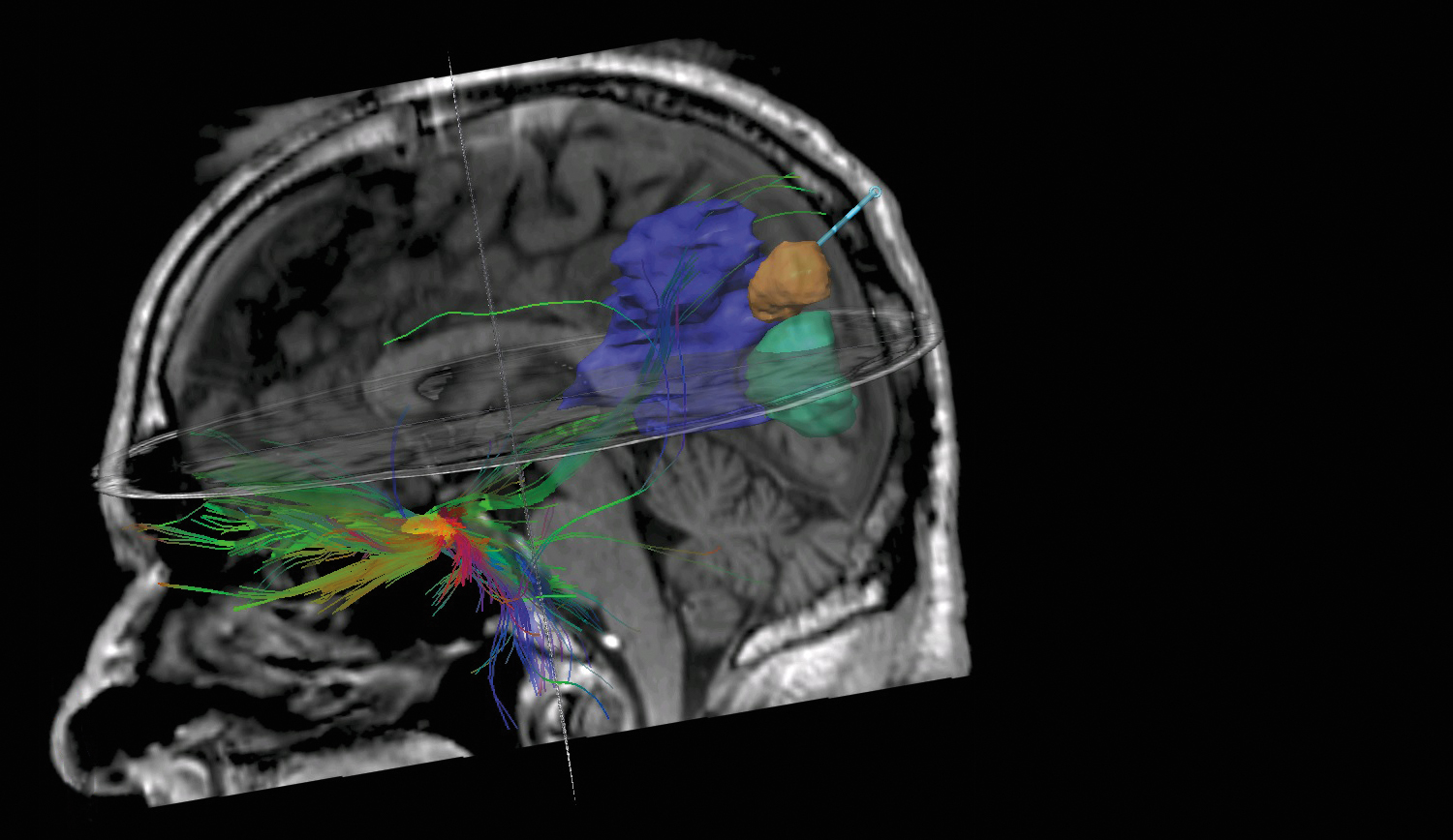 Brain_scan