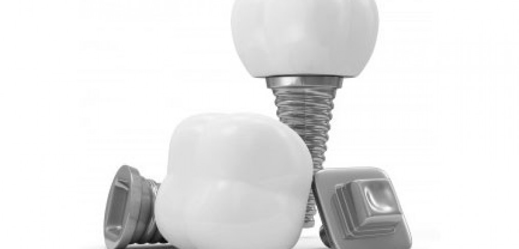 dental implants