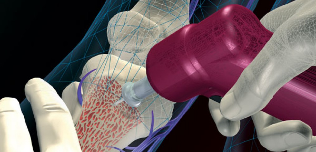 The EZ-IO provides access through the bone marrow cavity to quickly infuse blood, medications and fluids into critically ill patients who might die waiting for traditional IV lines.