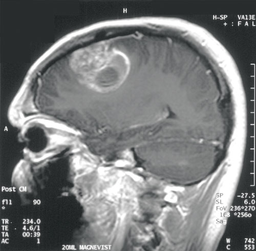brain_tumor