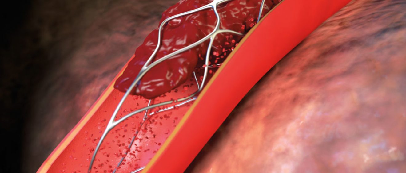 stent retriever illustration