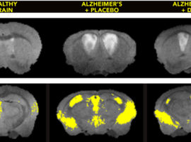 brain scans