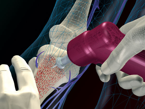 The EZ-IO provides access through the bone marrow cavity to quickly infuse blood, medications and fluids into critically ill patients who might die waiting for traditional IV lines.