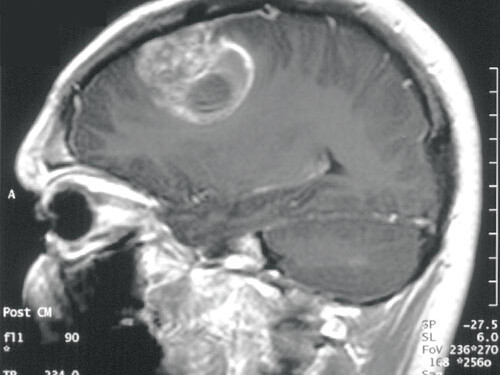 brain_tumor