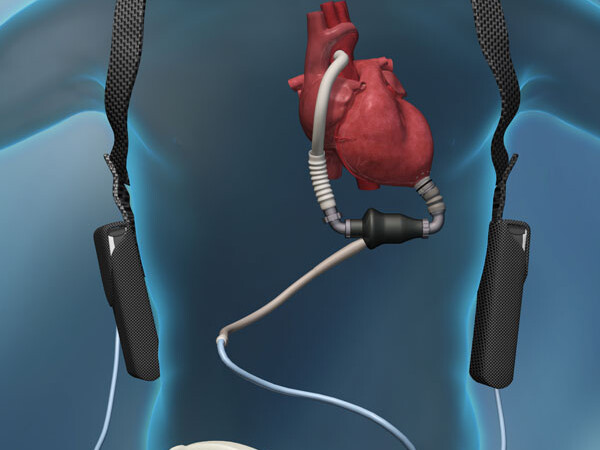 Surgery to implant a compact, lightweight ventricular assist device called HeartMate II®