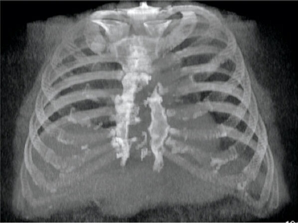 breastbone_mechanics