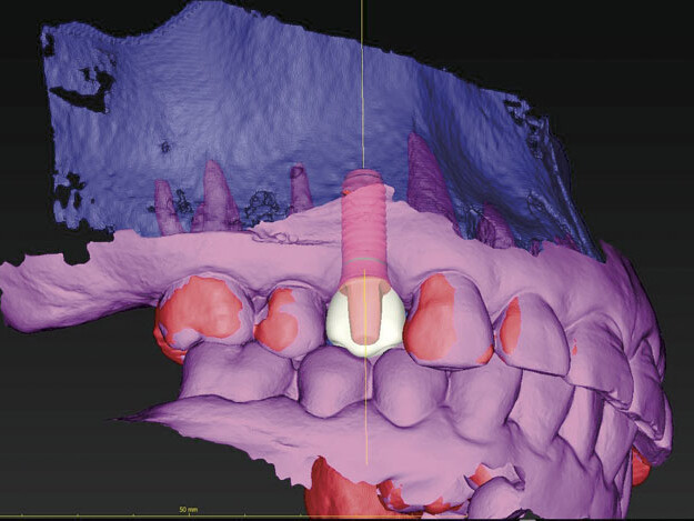 new imaging technology for planning implants