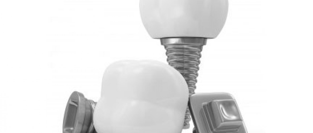 dental implants