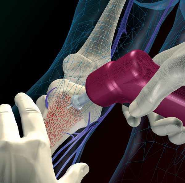 The EZ-IO provides access through the bone marrow cavity to quickly infuse blood, medications and fluids into critically ill patients who might die waiting for traditional IV lines.