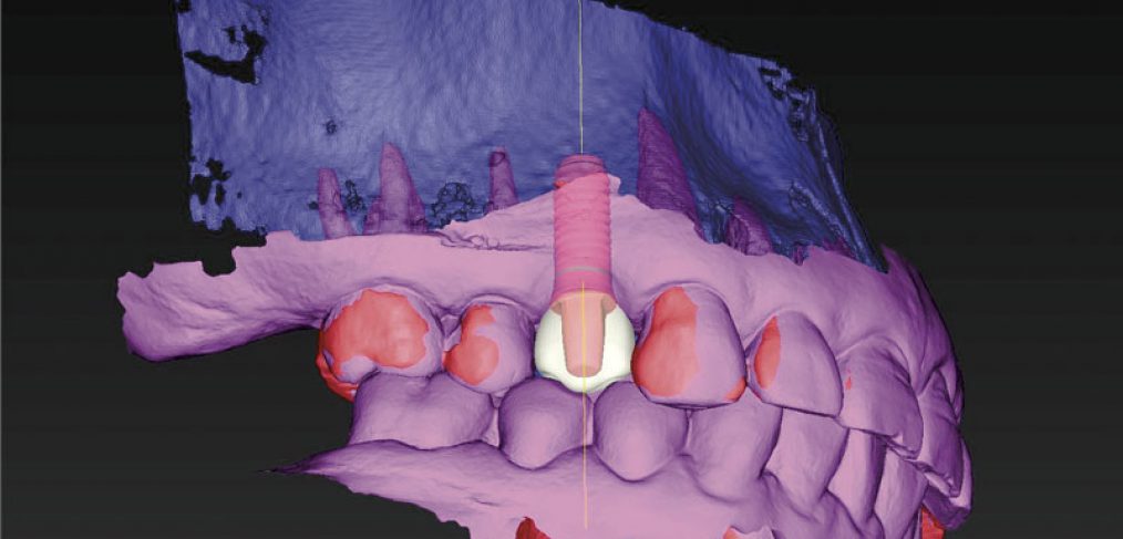 new imaging technology for planning implants