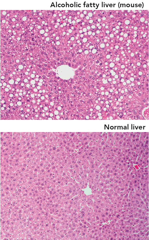 Alcoholic fatty liver (mouse) versus normal liver