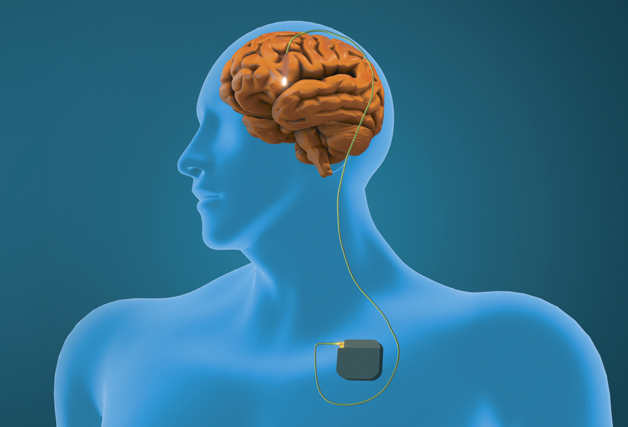 Graphic of a digram of the location of a pacemaker and its connection to the brain.